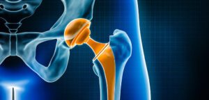 hip replacement surgery