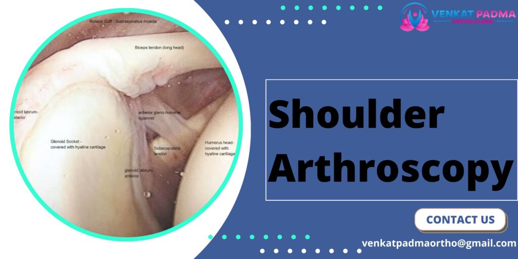 Shoulder Arthroscopy